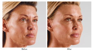 Juvederm before and after